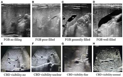Development and Assessment of Screening Nomogram for Biliary Atresia Based on Hepatobiliary Ultrasonographic Features